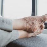 Thrombose – Ursachen und Therapie